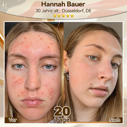 🌿𝑬𝐷𝐼𝐽𝑂𝑁𝐴𝐻® 𝑆𝑡𝑎𝑚𝑚𝑧𝑒𝑙𝑙𝑒 𝐸𝑥𝑜𝑠𝑜𝑚-𝑆𝑒𝑟𝑢𝑚 - 🎎👩‍⚕️（ Wirkt Anti-Aging, reduziert Falten, verbessert die Festigkeit, steigert die Ausstrahlung, spendet intensive Feuchtigkeit.）